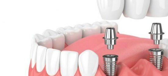 Implante dental fijo y removible - clinica dental molina de aragon