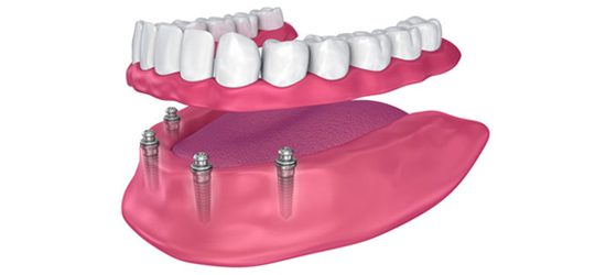Protesis dental fija y removible - clinica dental molina de aragon