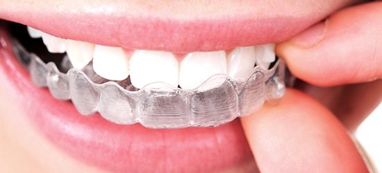 ortodoncia invisible removible invisaling- clinica dental molina de aragon
