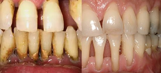 periodontitis – clinica dental molina de aragon periodontitis - clinica dental molina de aragon